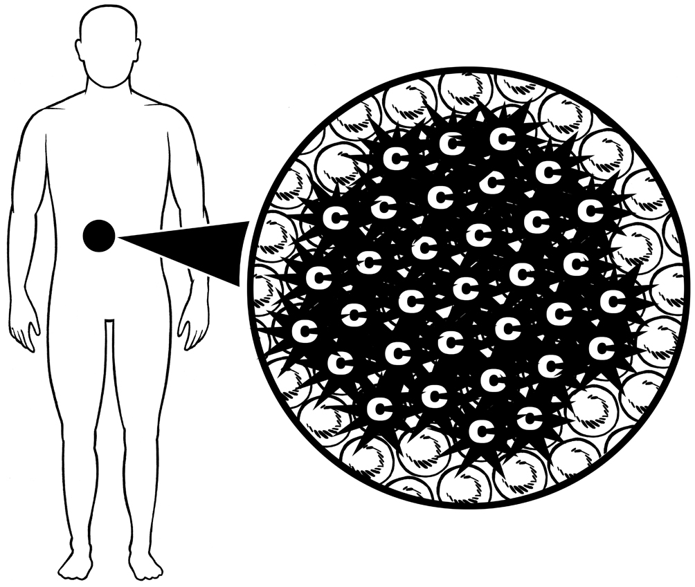 cancer tumour